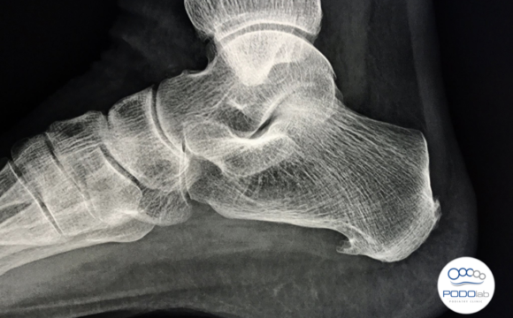 La Spina Calcaneale: Cause, Sintomi e Trattamento